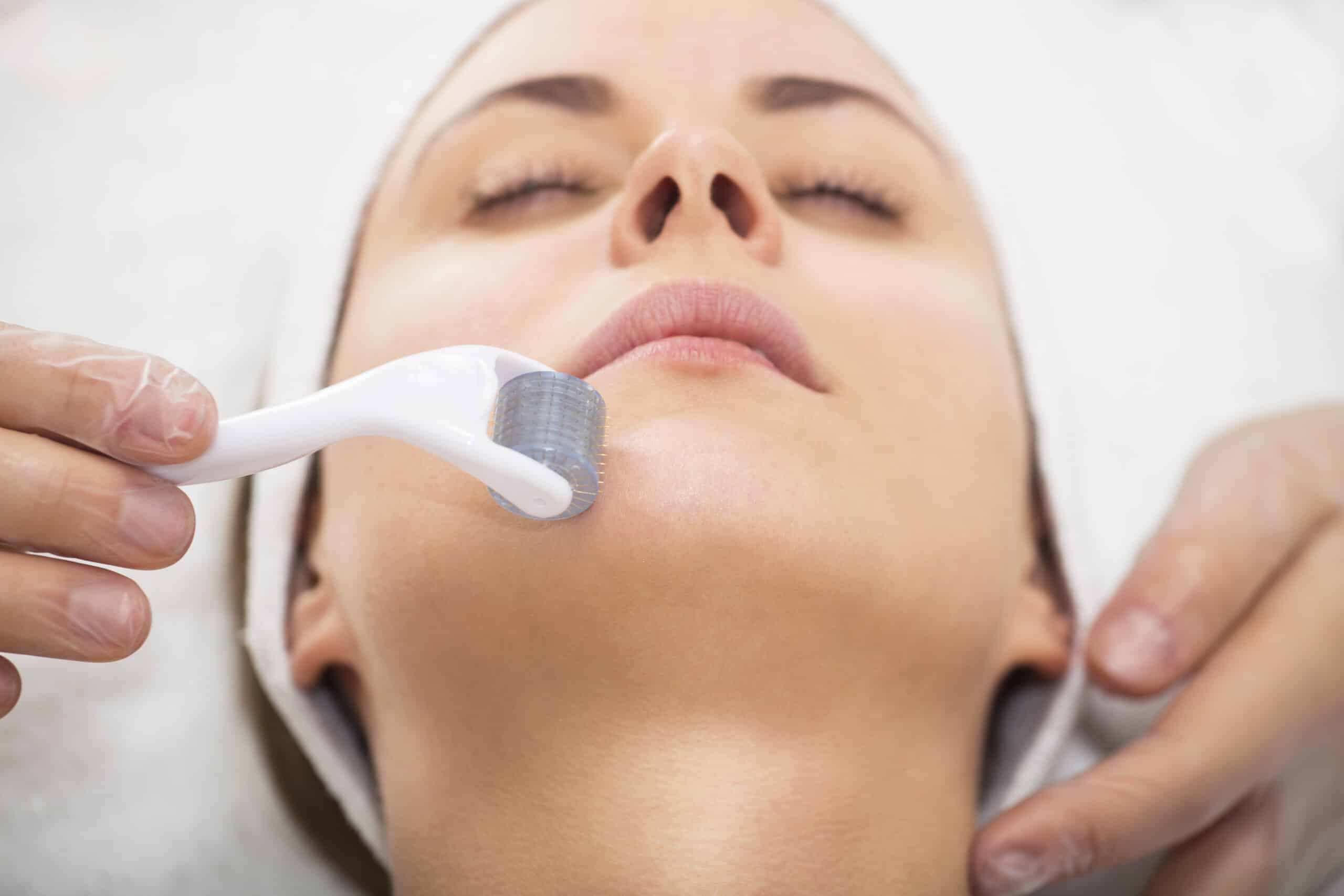 microneedling-Behandlung-mit-Dermaroller