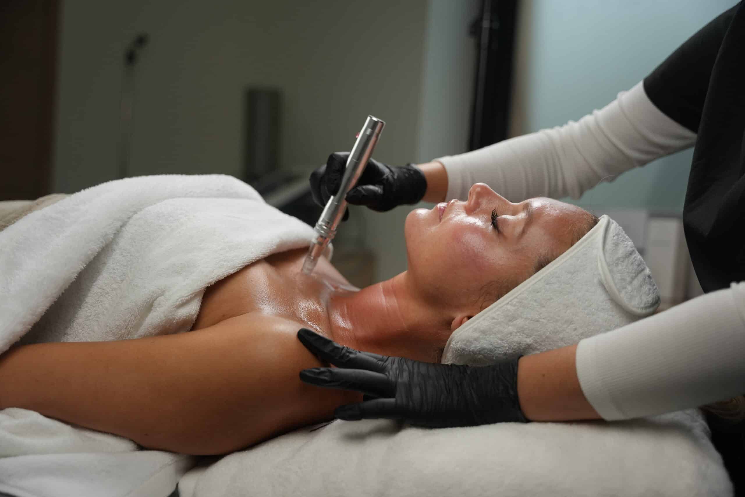 microneedling-behandlung-derma-pen